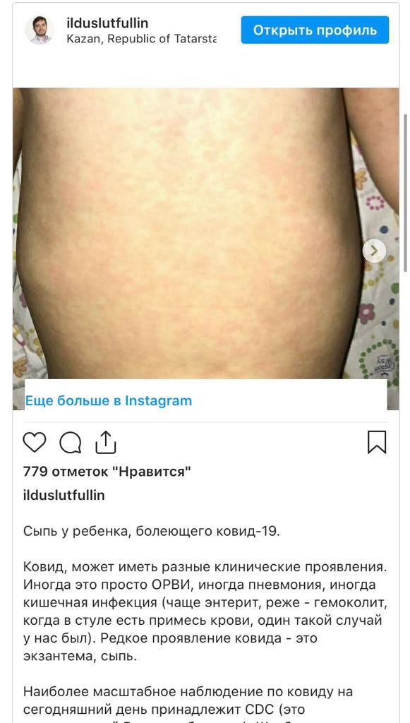 В Татарстане появилась разновидность Covid-19 в виде сыпи на коже
