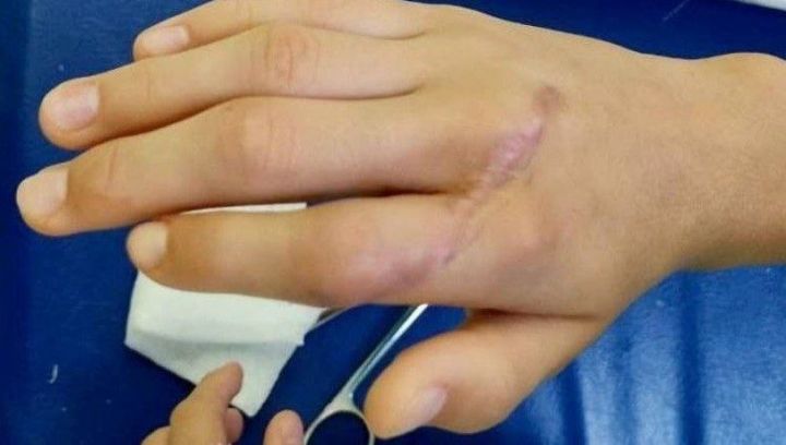 Врачи Татарстана спасли девочке палец, разрезанный «болгаркой»