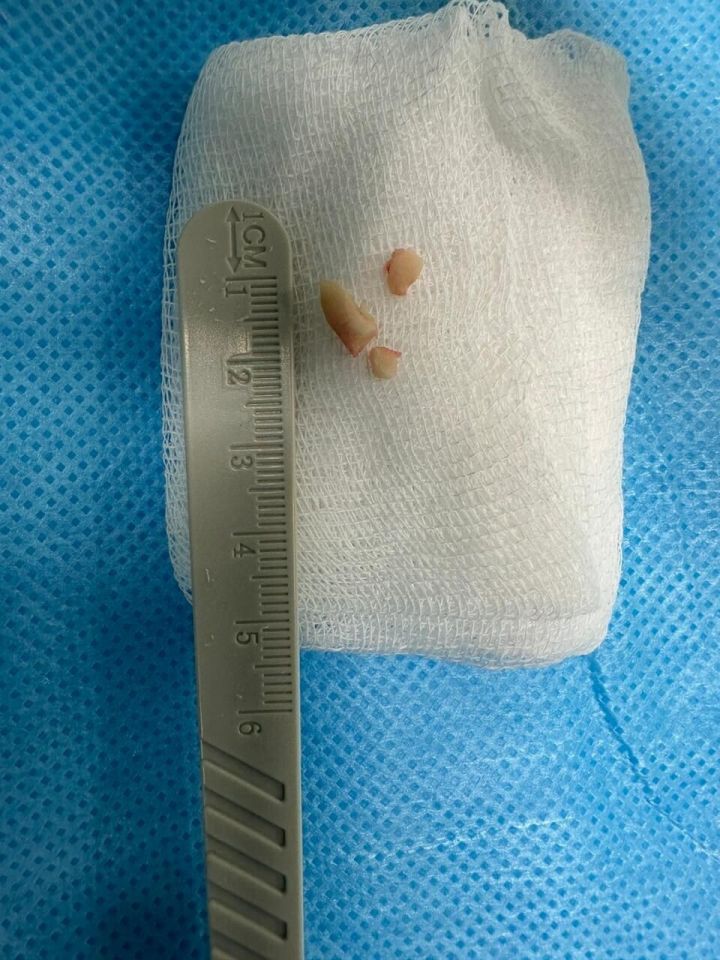 Врач ДРКБ удалил кусочки ореха из легких 11-месячного ребенка в Альметьевске